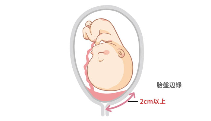 全前置胎盤のイメージ図